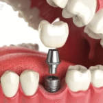 dental implants cost in Sydney