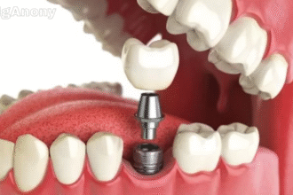 dental implants cost in Sydney