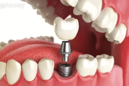 dental implants cost in Sydney