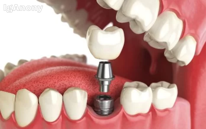 dental implants cost in Sydney