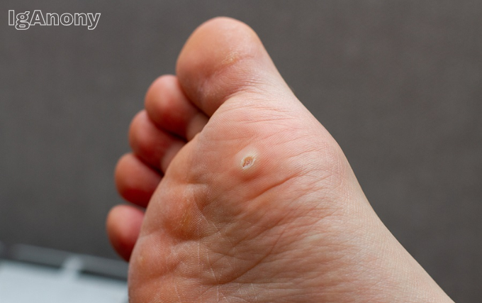 Swift wart therapy